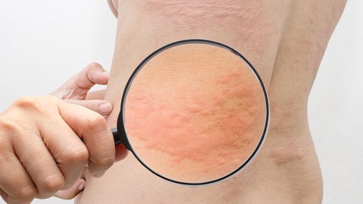 ¿Qué es la urticaria?