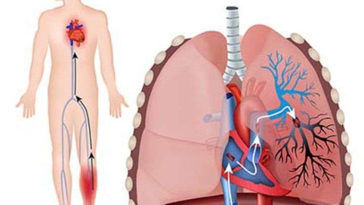 ¿Qué es la embolia pulmonar?