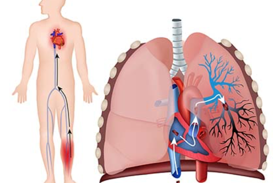 ¿Qué es la embolia pulmonar?